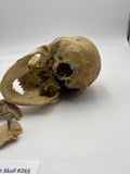 A Real Uncut Human Skull Damaged Temporal #265