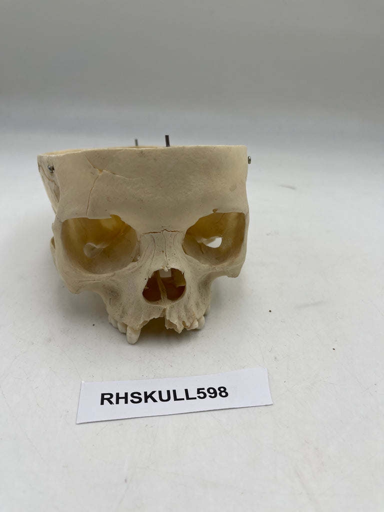 A Partial Pediatric Human Skull 598