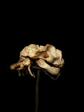 Pathology Anencephaly Fetal Human Skull